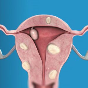 terapia dei fibromi uterini