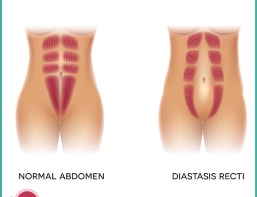 Diastasi dei muscoli retti addominali : fattori di rischio