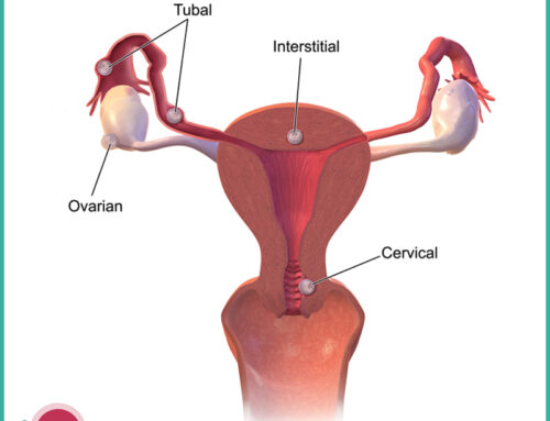 Trattamento chirurgico e non nella gravidanza extrauterina