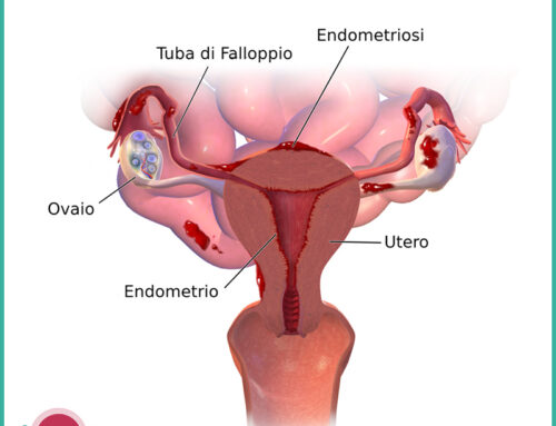 L’endometriosi