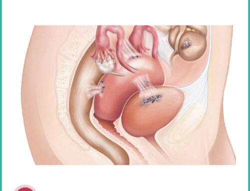 L’endometriosi ostetrica