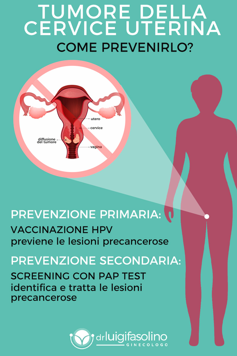 carcinoma della cervice uterina