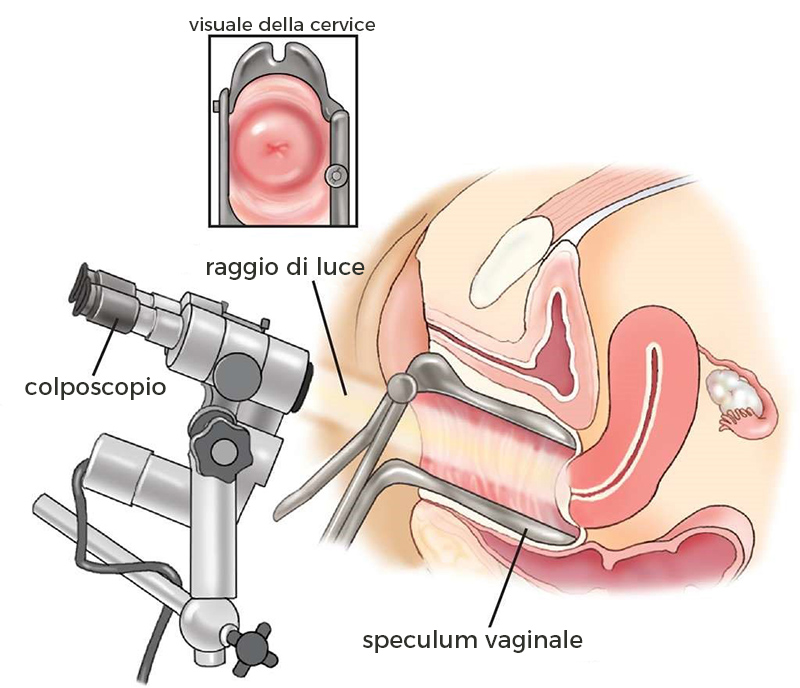 virus hpv colposcopia