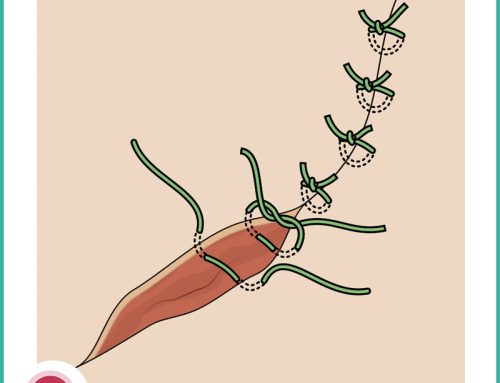 Diamoci un taglio: l’episiotomia