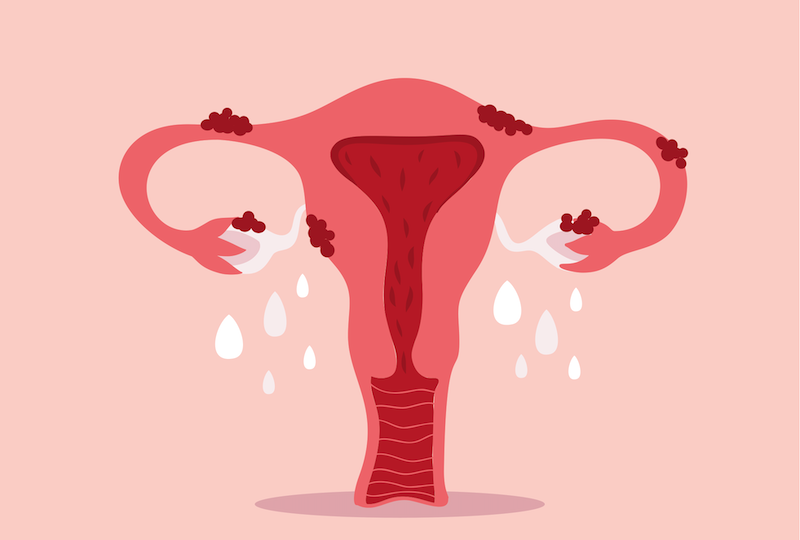 endometriosi e tumore