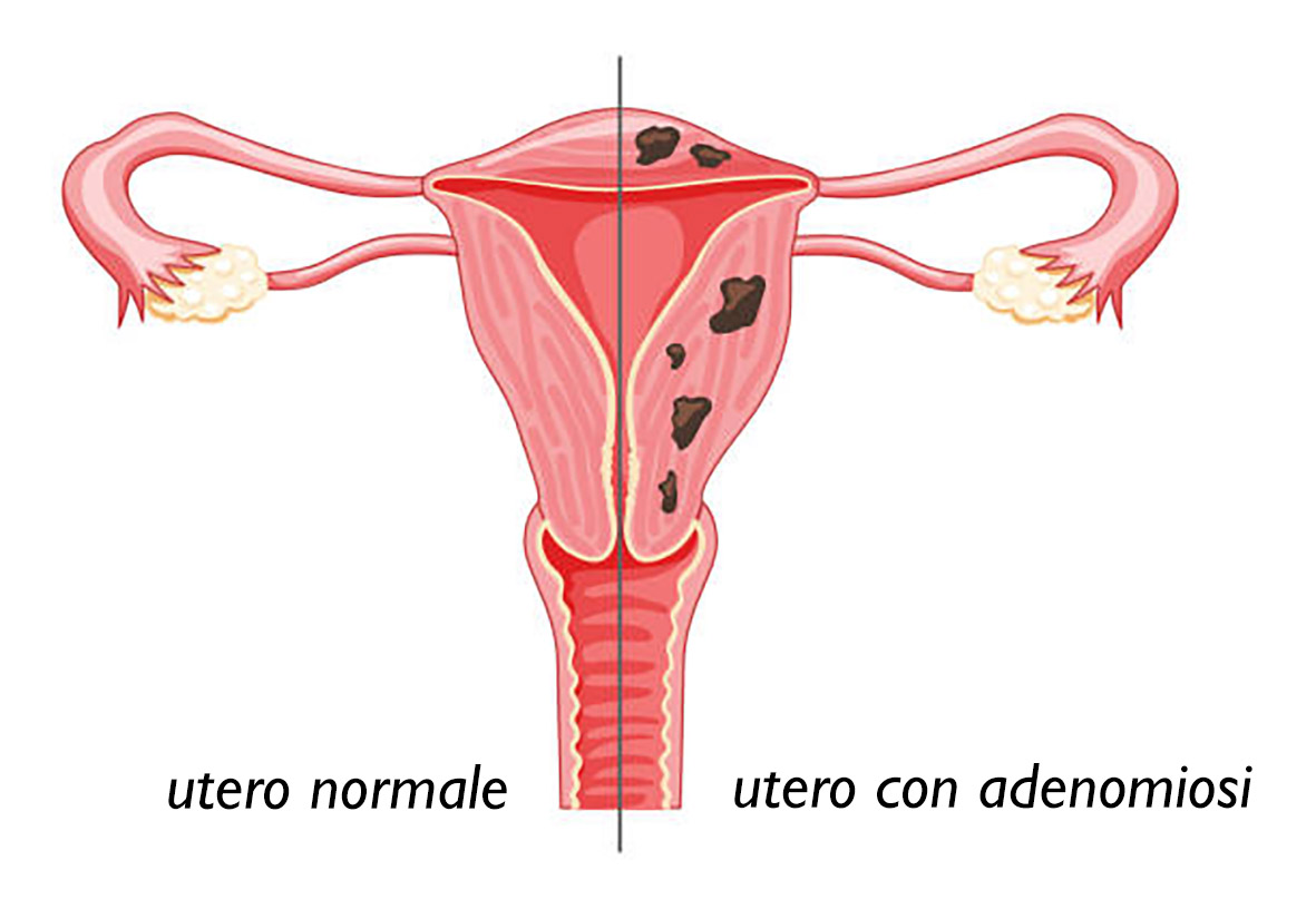 adenomiosi