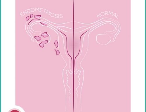 La stadiazione dell’endometriosi