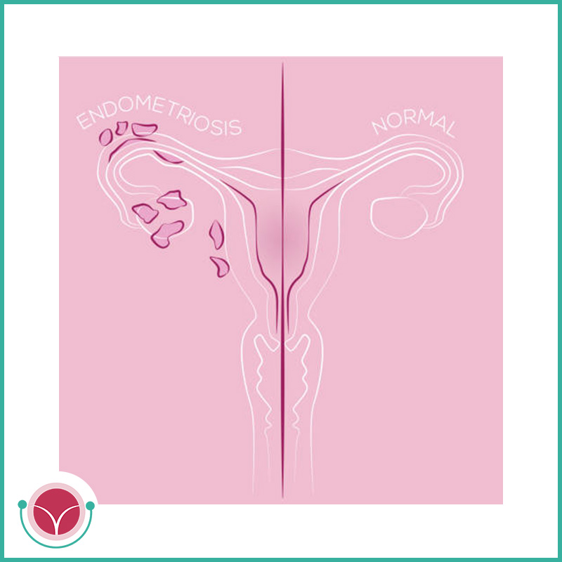 stadiazione endometriosi